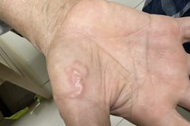 Nuôi chó mèo làm thú cưng, nhiều người bị sẩn ngứa, giun bò khắp cơ thể
