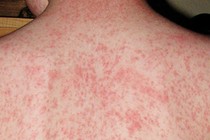 Món ăn bài thuốc phòng, trị bệnh sởi