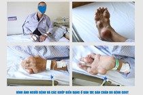 Rùng mình với tứ chi người đàn ông bị biến dạng khớp do bệnh Gout