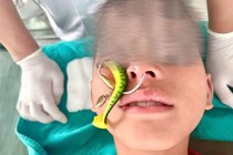 Đi câu, bệnh nhi 10 tuổi bị lưỡi câu găm vào sụn mũi 