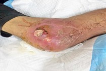 Người đàn ông biến chứng suy tuyến thượng thận do lạm dụng thuốc chứa corticoid