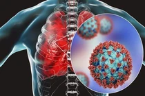 Virus HMPV gây viêm phổi đang lây lan ở Trung Quốc nguy hiểm thế nào?