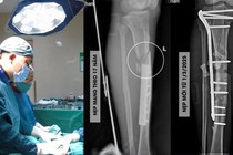 Tháo muộn nẹp vít làm tăng nguy cơ nứt, gãy xương