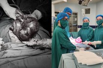 Uống thực phẩm chức năng, đa u xơ tử cung phát triển như thai 6 tháng