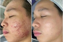  Chăm sóc da tránh mụn trứng cá ở tuổi dậy thì