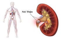 Địa chỉ vàng: Các bệnh viện điều trị sỏi thận tốt tại Hà Nội