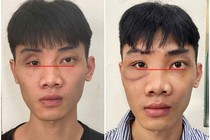 Tạo hình thành ổ mắt bằng công nghệ titan chữa mắt biến dạng sau tai nạn