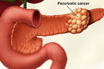 Dấu hiệu chứng tỏ bạn mắc ung thư tuyến tụy