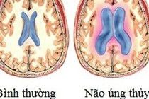 Bí ẩn căn bệnh não úng thủy của Quốc vương Thái Lan