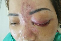 TPHCM: Kinh hãi cô gái mù mắt sau 5 phút tiêm filler ở spa