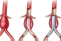 Các yếu tố gây bệnh bóc tách động mạch chủ