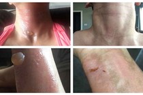 Bỏng độ 3 vì dùng tinh dầu sai cách