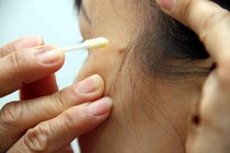 Chớ nên tẩy nốt ruồi bằng nhựa cây, vôi