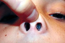 Cẩn thận u nhú mũi có xu hướng ác tính hóa