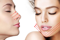 Bác sĩ cảnh báo nguy cơ khi cấy chỉ nâng mũi