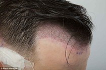 Cấy tóc sinh học dễ tăng sừng hóa, viêm da đầu