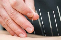 Châm cứu có thải được sỏi?