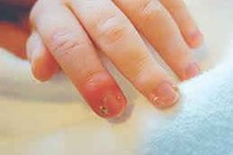 Ngâm nước muối khi bị chín mé