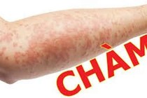 Chữa chàm bằng lá cây