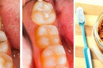 Răng sâu nặng hơn vì chữa bằng bột nghệ pha dầu dừa