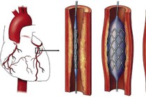 Đặt stent nong mạch vành