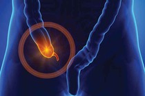 Mẹ nhầm đau ruột thừa với bụng kinh, con suýt mất mạng