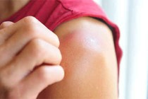 Dấu hiệu khi bị cháy nắng
