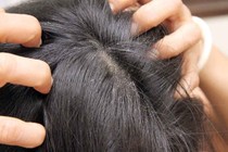Khắc phục đầu ngứa, nhiều gàu