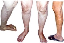Đi bộ nhiều căng tức chân