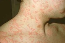 Nhận biết dị ứng cùng phản ứng có hại do thuốc