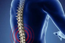 Phẫu thuật gai cột sống dễ tái phát
