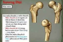 Gẫy lồi cầu xương đùi ảnh hưởng tới vận động khớp gối