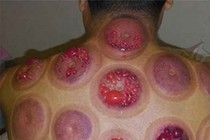 Giác hơi sai thêm tai họa
