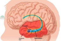 Viêm màng não và giun phổi chuột