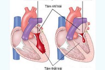 Thấp tim và hẹp van hai lá