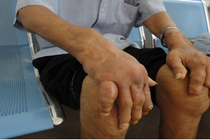 Người mắc Gout ngày càng trẻ hóa