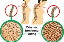 Lún xẹp cột sống do loãng xương