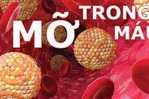 Cholesterol máu cao không có triệu chứng rõ rệt