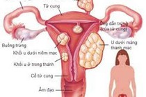 Mổ u buồng trứng vẫn có con