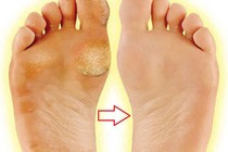 Ngâm chân trong giấm để chữa 4 bệnh hay gặp: Chỉ cần 15 phút/ngày, ai cũng nên làm