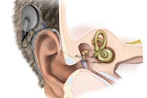 Người bị điếc nặng mới cấy ốc tai