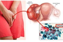 Thai phụ nhiễm Chlamydia, con dễ nhiễm trùng mắt, mù
