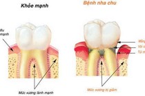Phát hiện viêm nha chu muộn, nguy cơ mất răng