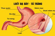 Điểm danh 3 “thủ phạm” chính gây trào ngược dạ dày – thực quản