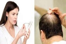 Thảo dược trị chứng rụng tóc