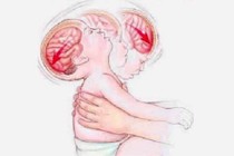 Não trẻ bị ảnh hưởng nghiêm trọng thế nào khi bị rung lắc, quăng quật?