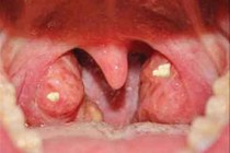 Gù vẹo do sùi vòm họng