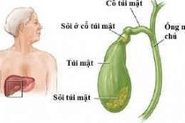 Các phương pháp điều trị sỏi mật hiệu quả