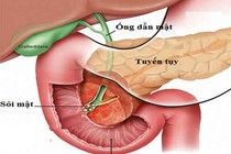 Những sai lầm trong cách ăn gây bệnh sỏi mật