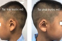 Tạo hình nhiều vạt tái tạo lại tai bị vùi dưới da đầu
